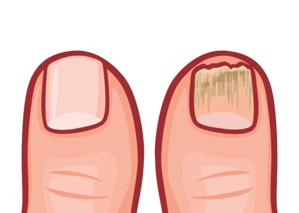 μυκητίαση-νυχιών-ποδολογικό-αγρίνιο